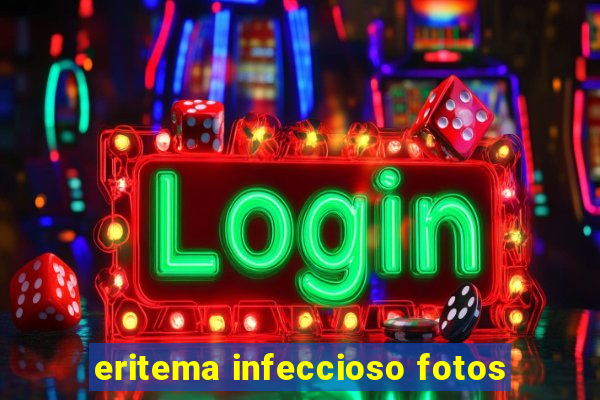 eritema infeccioso fotos